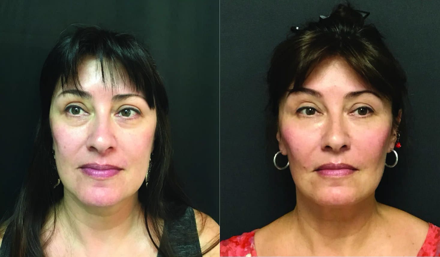 On the left, a woman with visible facial wrinkles before Bellafill treatment. On the right, the same woman with smoother, rejuvenated skin after receiving Bellafill injections.