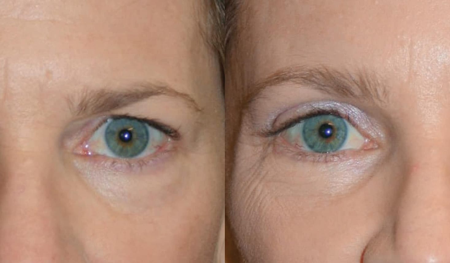 Upper and Lower Eyelid Blepharoplasty before and after