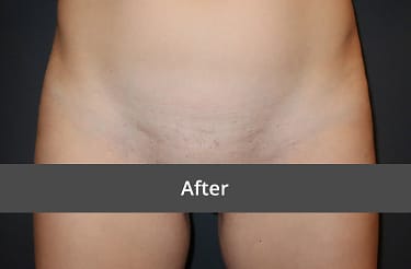 After Labiaplasty/Labial Reduction