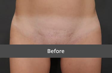 Before Labiaplasty/Labial Reduction