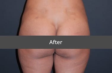 BBL surgery: meaning, results, before and after photos, prices