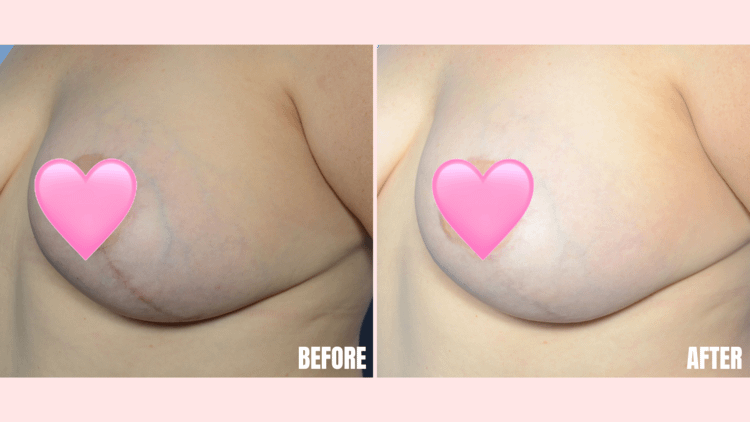 Breast Augmentation Redlands California