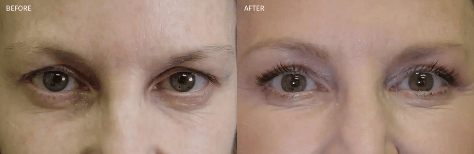 Bilateral Upper Eyelid Blepharoplasty before and after