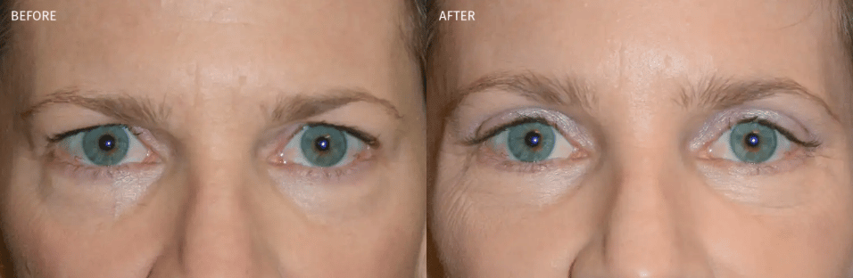 Upper and Lower Eyelid Blepharoplasty with Endoscopic Brow Lift before and after