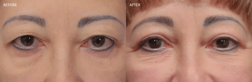 Bilateral Upper Eyelid Blepharoplasty Before and after