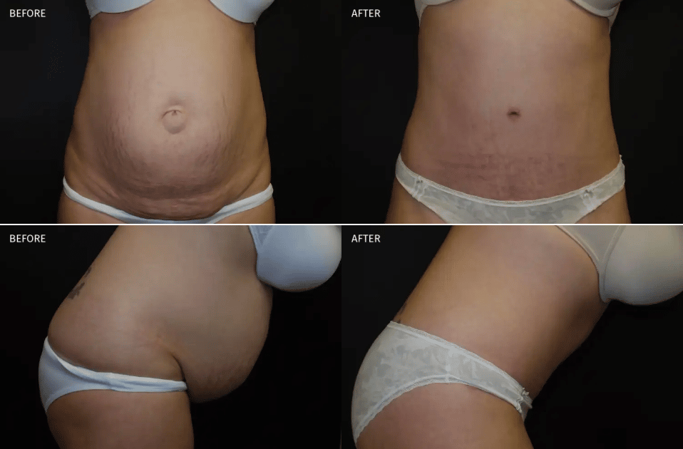 Tummy tuck Temecula California before and after image 