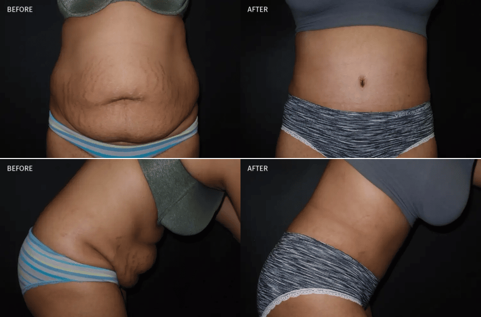Tummy Tuck Temecula before and after results