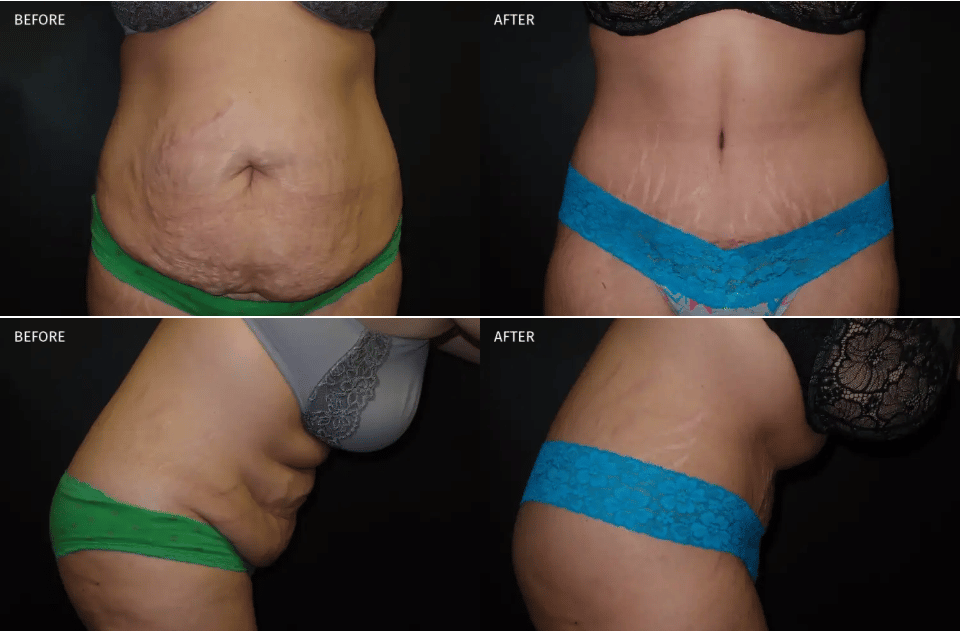 Tummy Tuck Temecula before and after image - informational